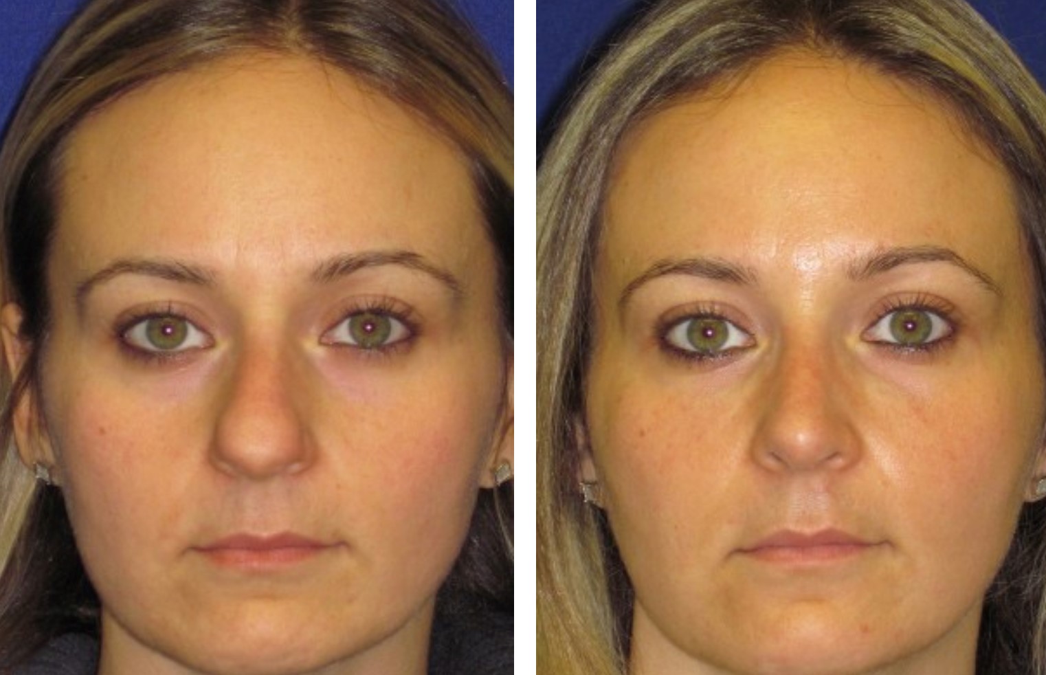 14 dicas de recuperação de rinoplastia que você precisa saber