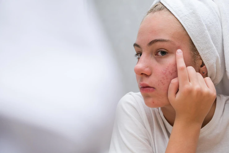 Como lidar com as cicatrizes de acne?