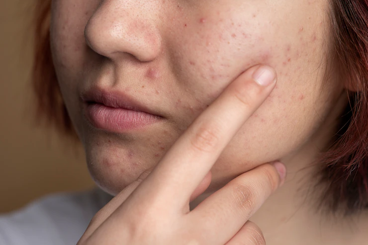 Como prevenir a acne?