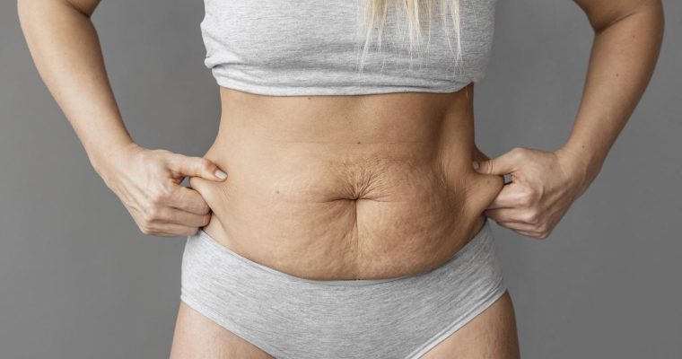 Abdominoplastia: tudo sobre a cirurgia que vai deixar a sua barriga chapada