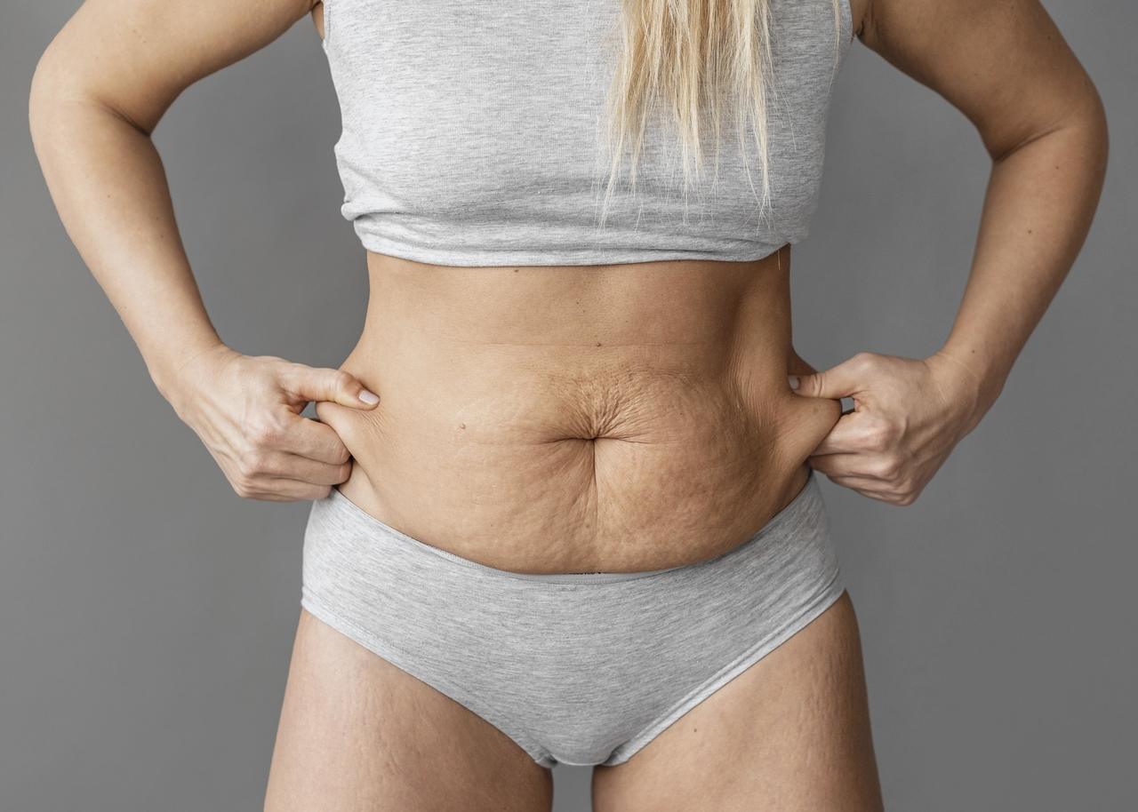 Abdominoplastia: tudo sobre a cirurgia que vai deixar a sua barriga chapada