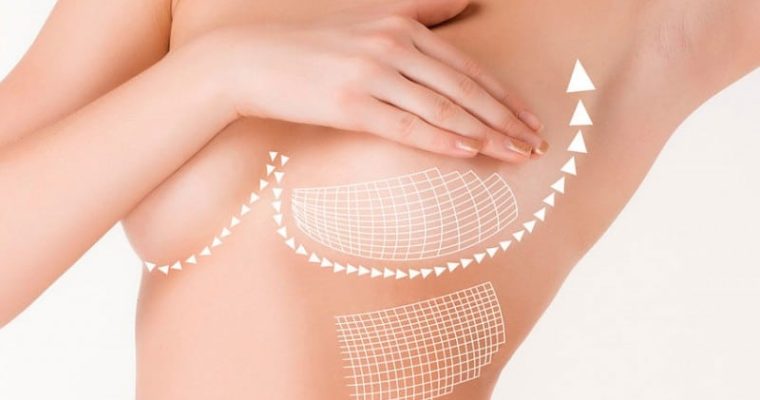 Mamoplastia redutora: tudo o que você precisa saber