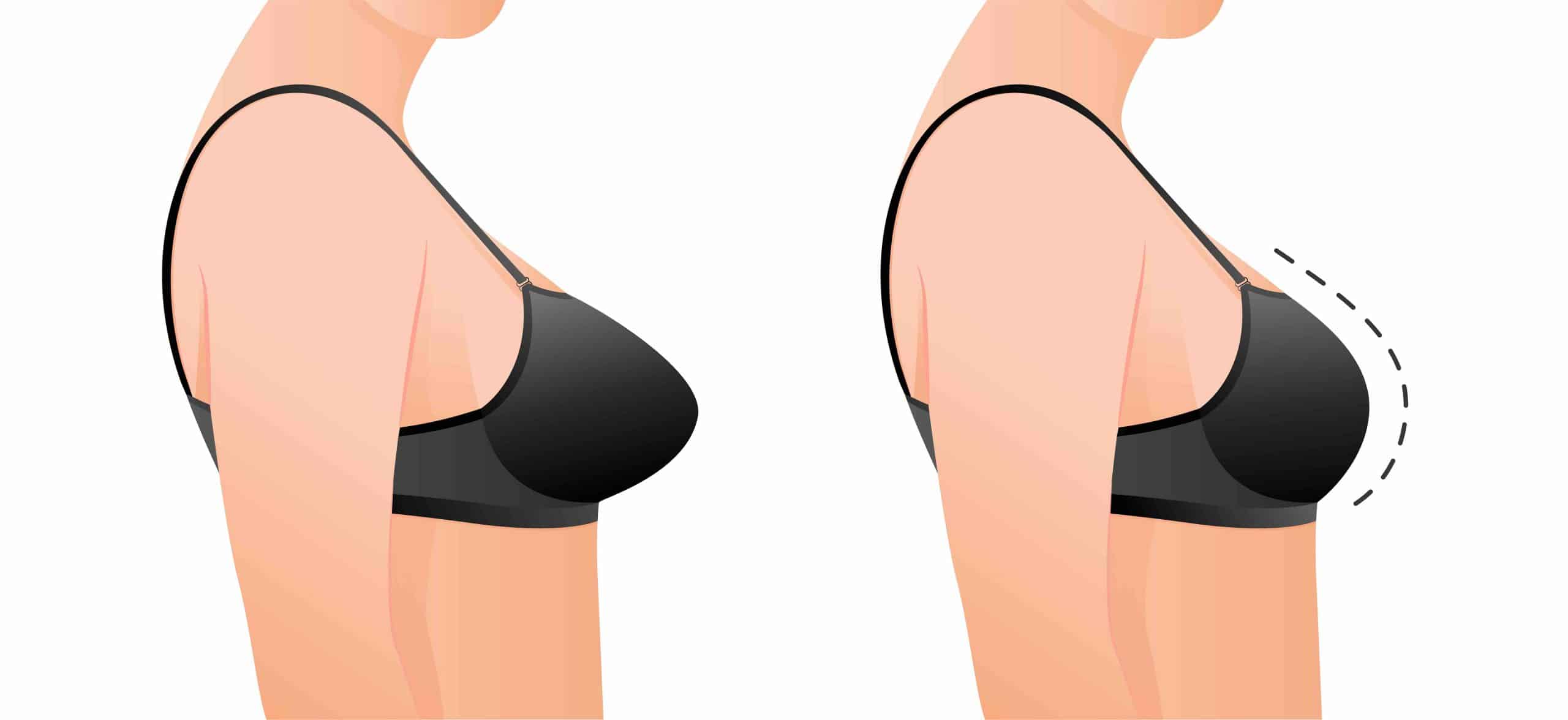 Como a mamoplastia pode melhorar a autoestima da mulher