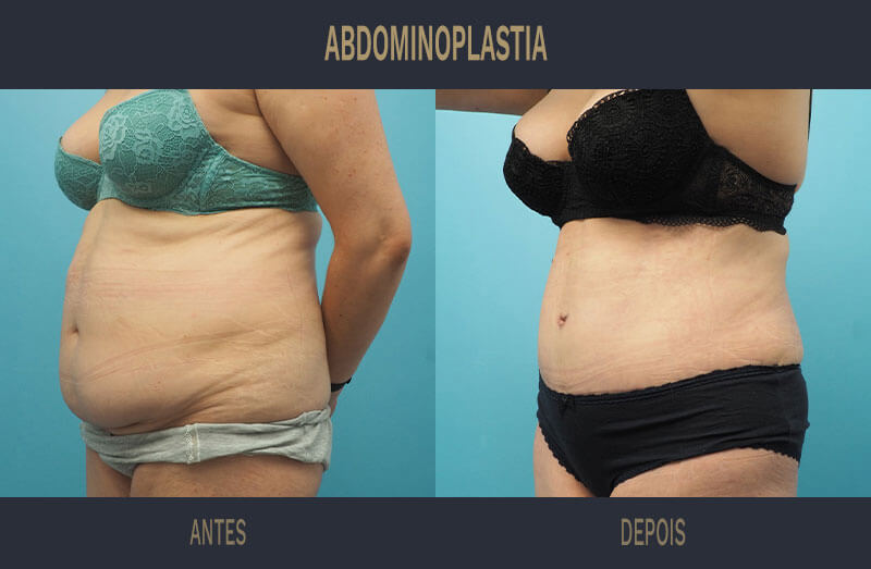 Abdominoplastia: o que é, como é feita e quais são os riscos? - Formula