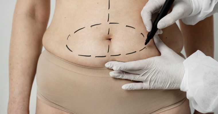 Abdominoplastia: o que é, como é feita e quais são os riscos?