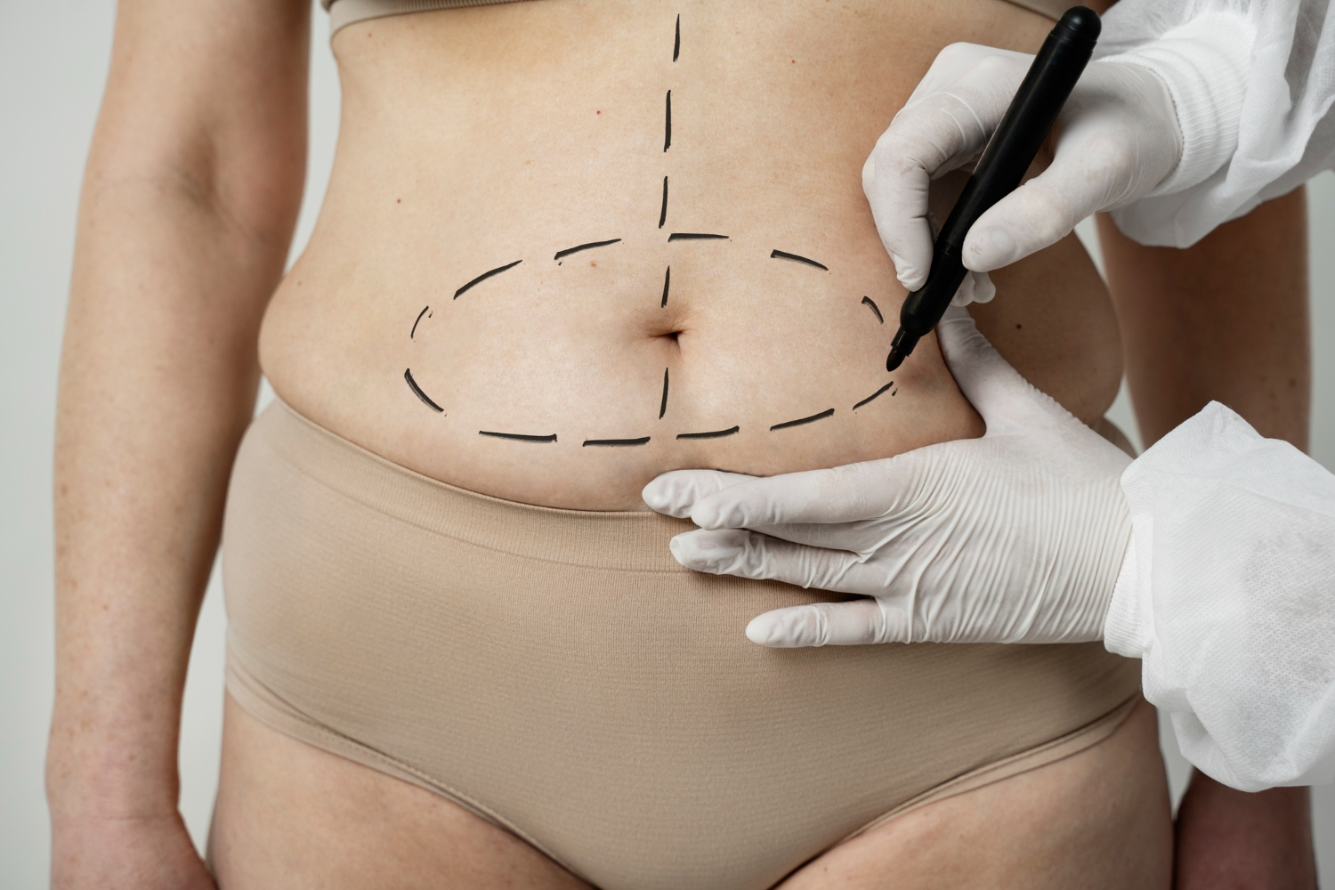 Abdominoplastia: o que é, como é feita e quais são os riscos?