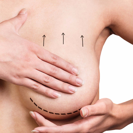 Mastopexia: O que é, como é feita e quais são os benefícios?