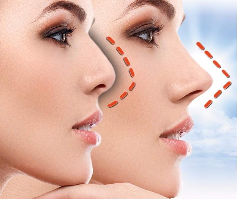 Rinoplastia Secundária: o que esperar