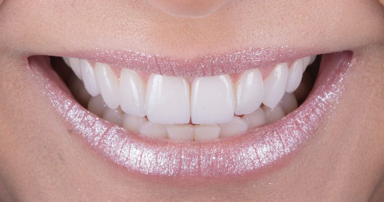 Clareamento dental: Como ter o sorriso brilhante e saudável