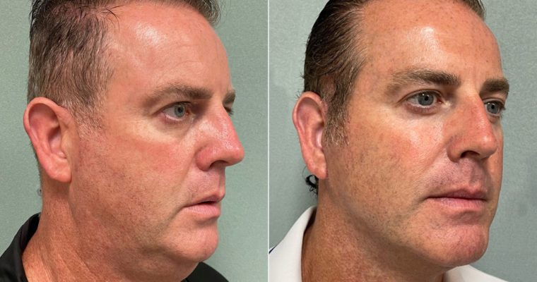 Rejuvenesça com Facelift: Guia Completo para um Novo Visual