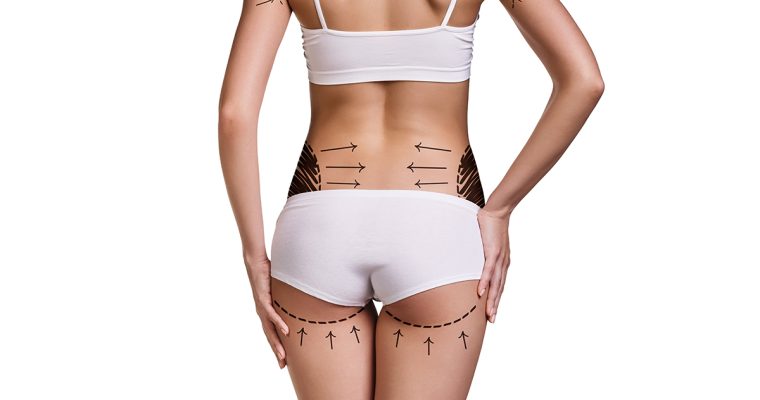 Gluteplastia: A Solução Ideal para Aumentar e Definir seus Glúteos