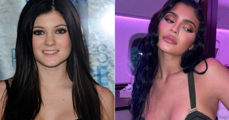 Kylie Jenner e a Cirurgia aos 19: Uma Análise Sobre a Pressão da Beleza e as Implicações