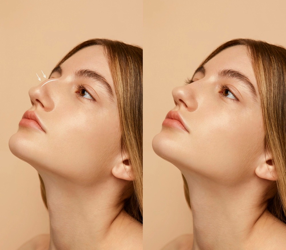 Tipos de Rinoplastia: 5 Coisas que Você Precisa Saber