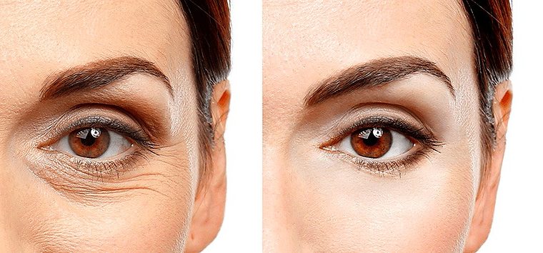 Cuidando de si mesmo após sua blefaroplastia