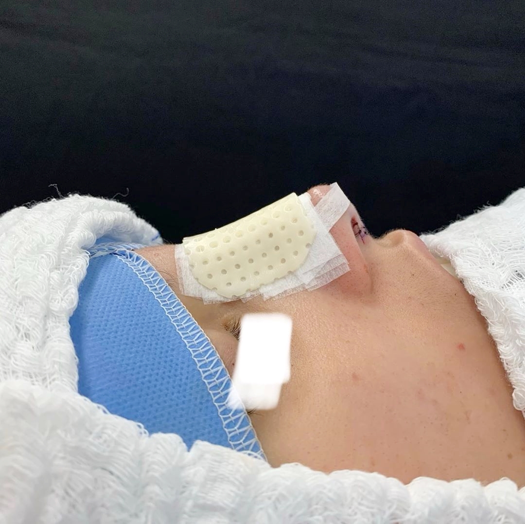 10 dicas para acelerar o tempo de recuperação da rinoplastia