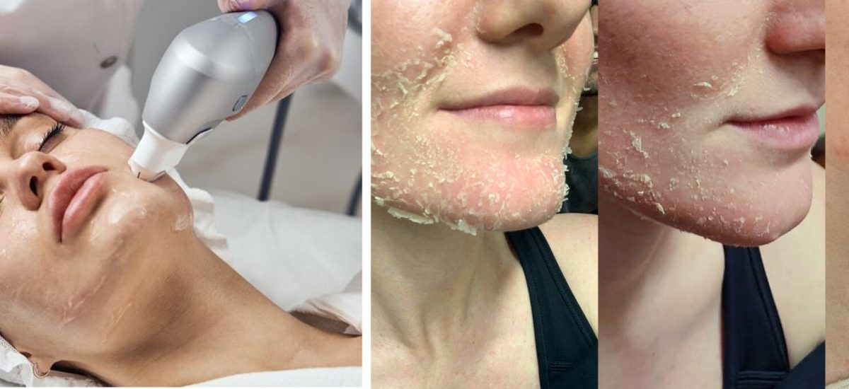 APhen Peel®: A Evolução do Peeling Químico: Mais Seguro e Eficaz