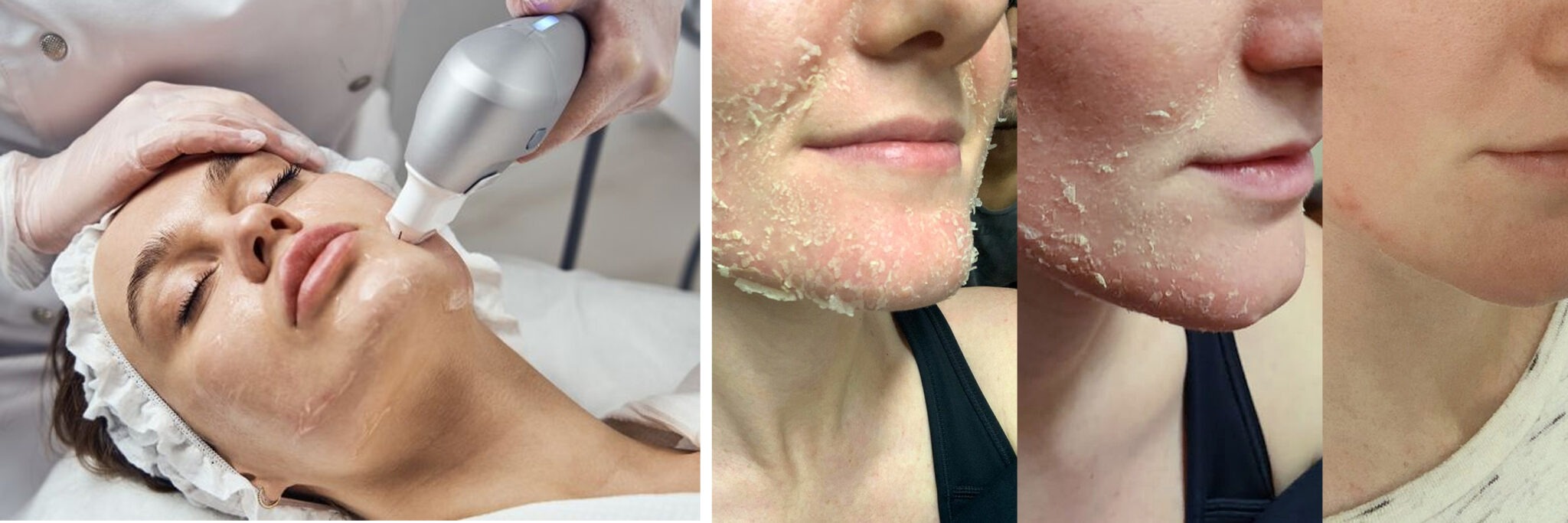 APhen Peel®: A Evolução do Peeling Químico: Mais Seguro e Eficaz